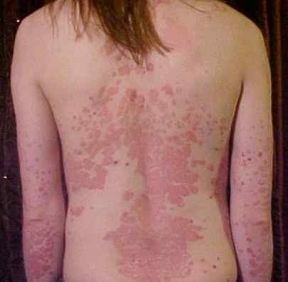 Différence entre la dermatite séborrhéique et le psoriasis