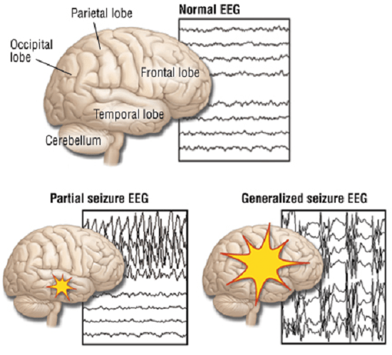 Perbezaan antara penyitaan dan epilepsi