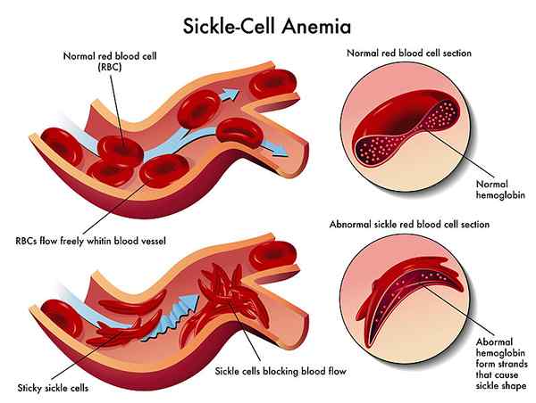 Perbezaan antara anemia sel sabit dan talasemia