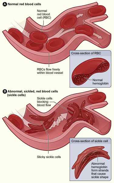 Diferencia entre la enfermedad de las células falciformes y la anemia de las células falciformes