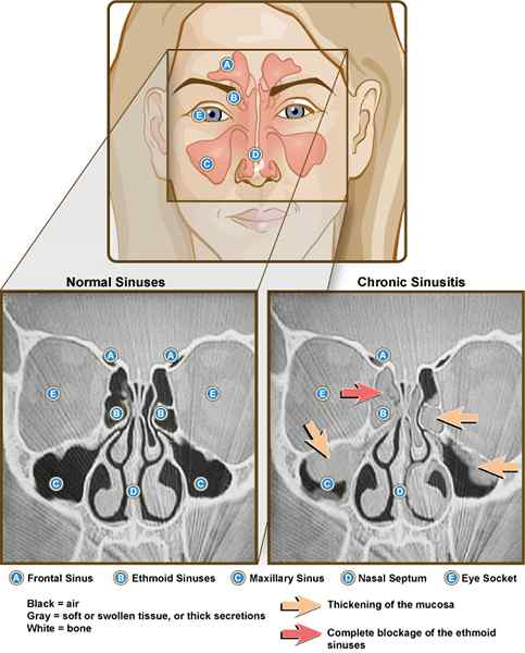 Différence entre les sinus et les allergies
