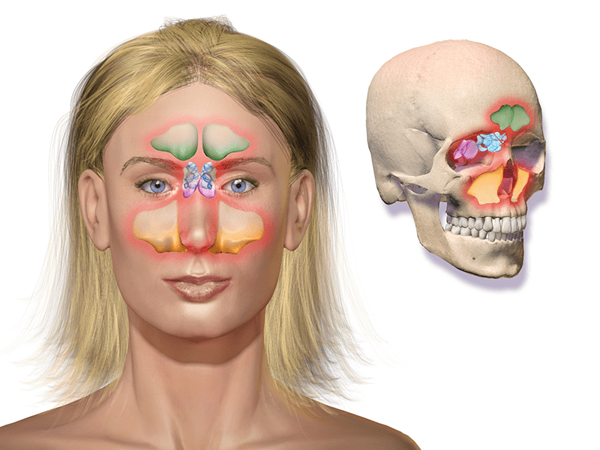 Diferencia entre la sinusitis y la rinosinusitis