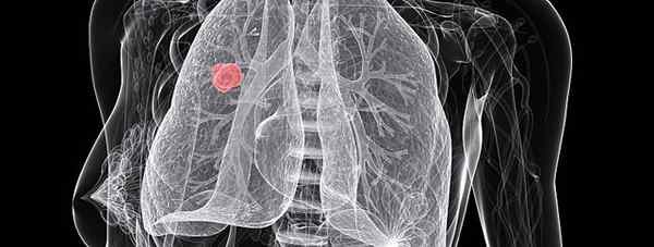 Diferencia entre el cáncer de pulmón de células pequeñas y de células pequeñas