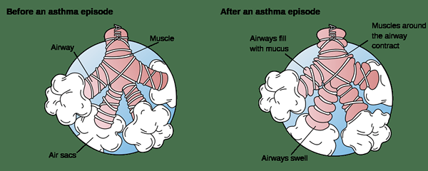 Différence entre le stridor et la respiration sifflante