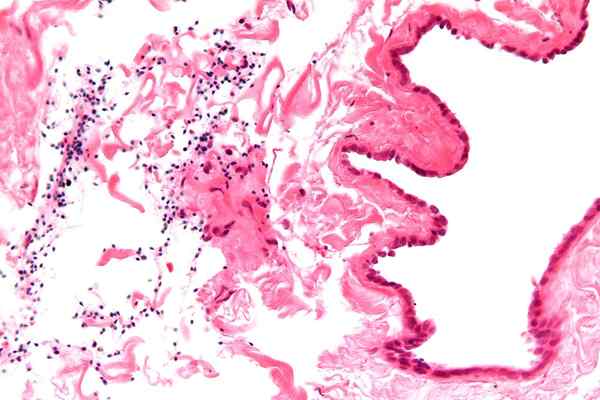 Diferencia entre el cáncer testicular y el quiste (quiste escrotal)