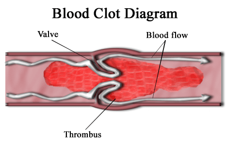 Différence entre le thrombus et l'embolie