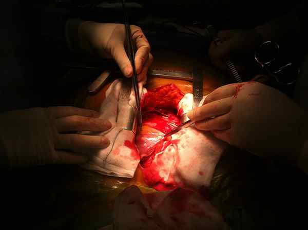 Unterschied zwischen dreifacher Bypass und Operation im Freien Herz