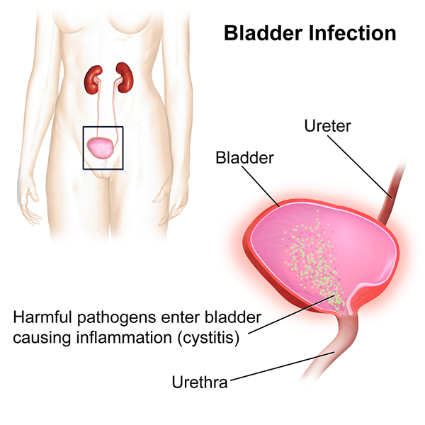 Diferencia entre la infección urinaria y la infección de la vejiga