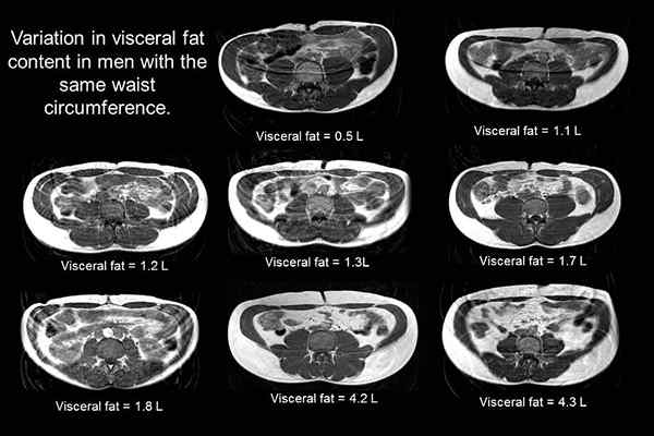 Différence entre la graisse viscérale et la graisse sous-cutanée