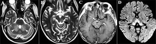 Perbezaan antara sindrom Wernicke encephalopathy dan Korsakoff