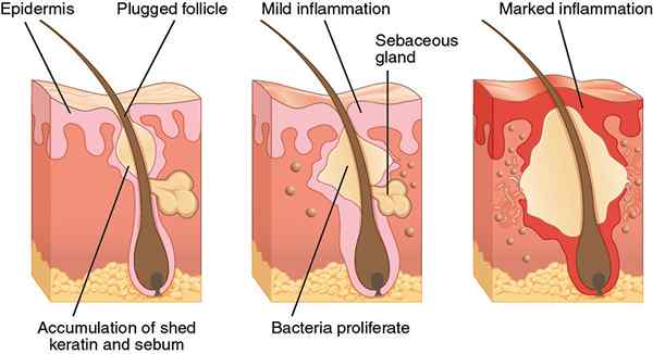 Diferencia entre ZIT y Pimple