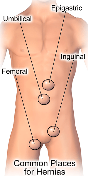 Cómo notar la diferencia entre la tensión de la ingle y la hernia